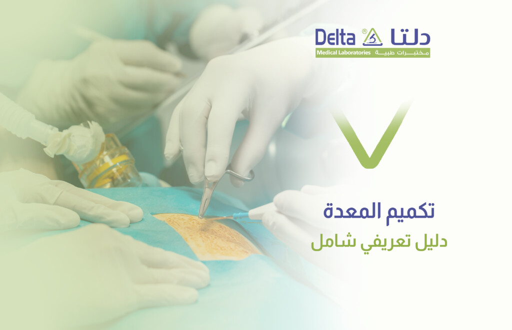 تكميم المعدة