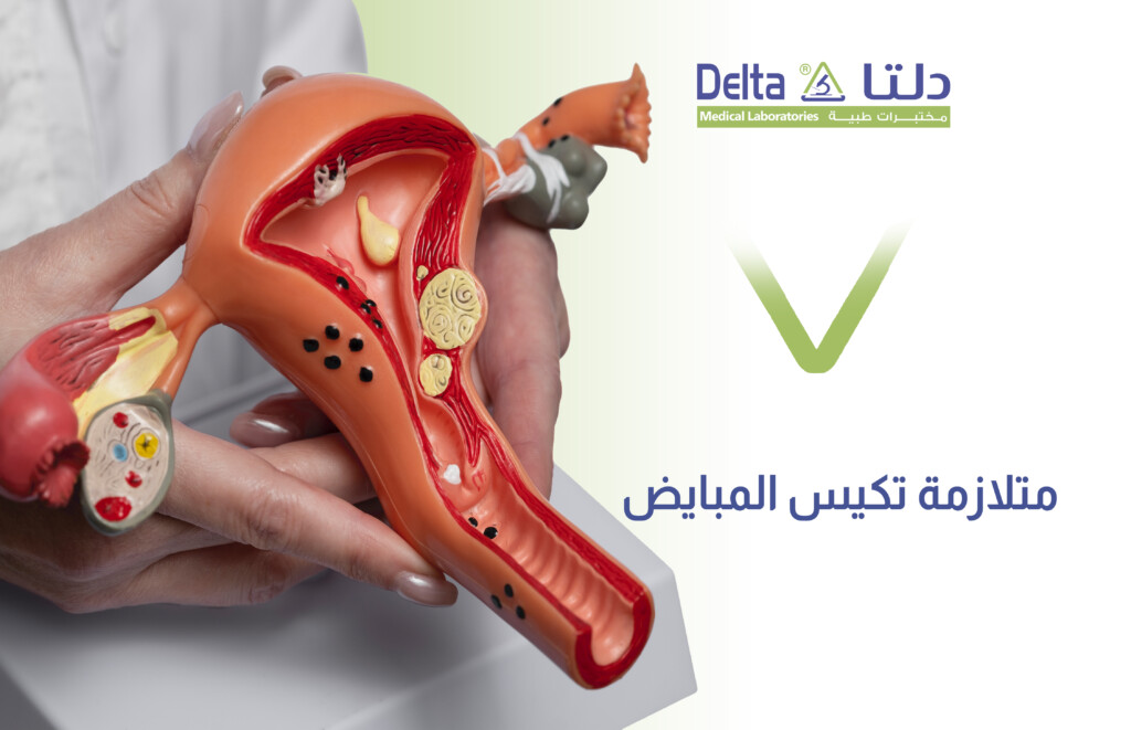 متلازمة تكيس المبايض