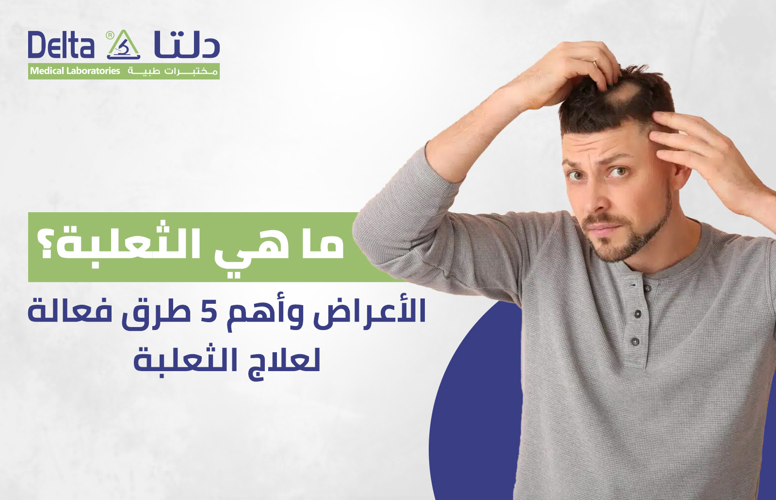 ما هي الثعلبة؟ الأعراض وأهم 5 طرق فعالة لعلاج الثعلبة