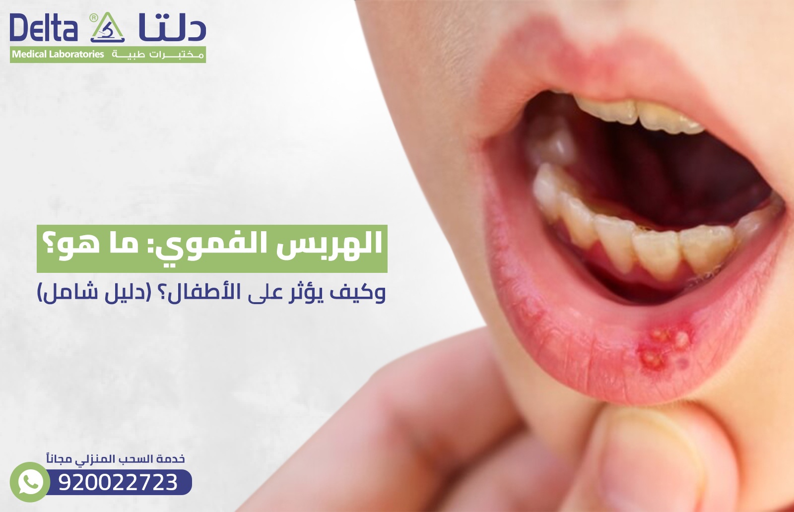 الهربس الفموي : ما هو؟ وكيف يؤثر على الأطفال؟ (دليل شامل)