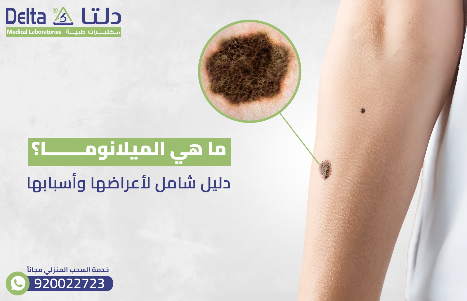 ما هي الميلانوما ؟ دليل شامل لأعراضها وأسبابها