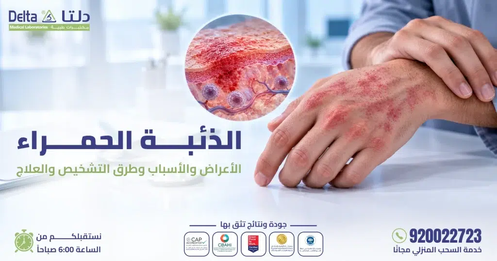 الذئبة الحمراء: الأعراض والأسباب وطرق التشخيص والعلاج