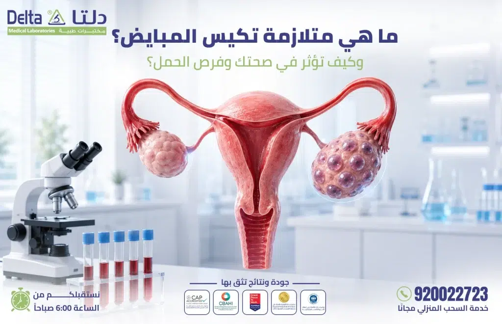 متلازمة تكيس المبايض PCOS - الأعراض والتشخيص والعلاج