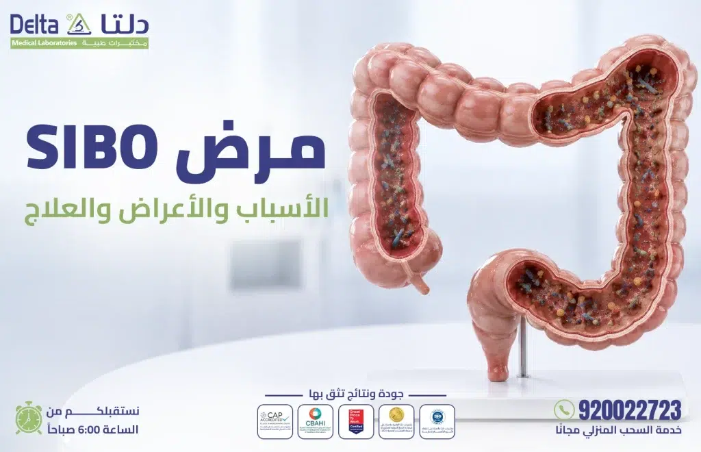 فحص SIBO لتشخيص فرط نمو البكتيريا في الأمعاء الدقيقة في مختبرات دلتا الطبية